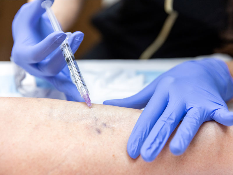 Microsclérothérapie Sclérothérapie