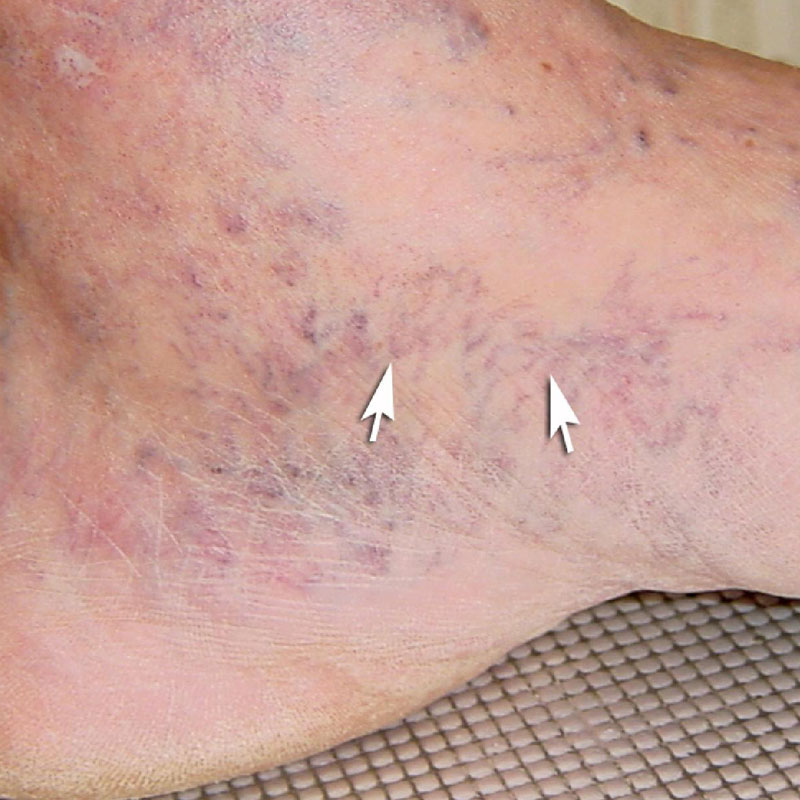 Corona Phlebectatica